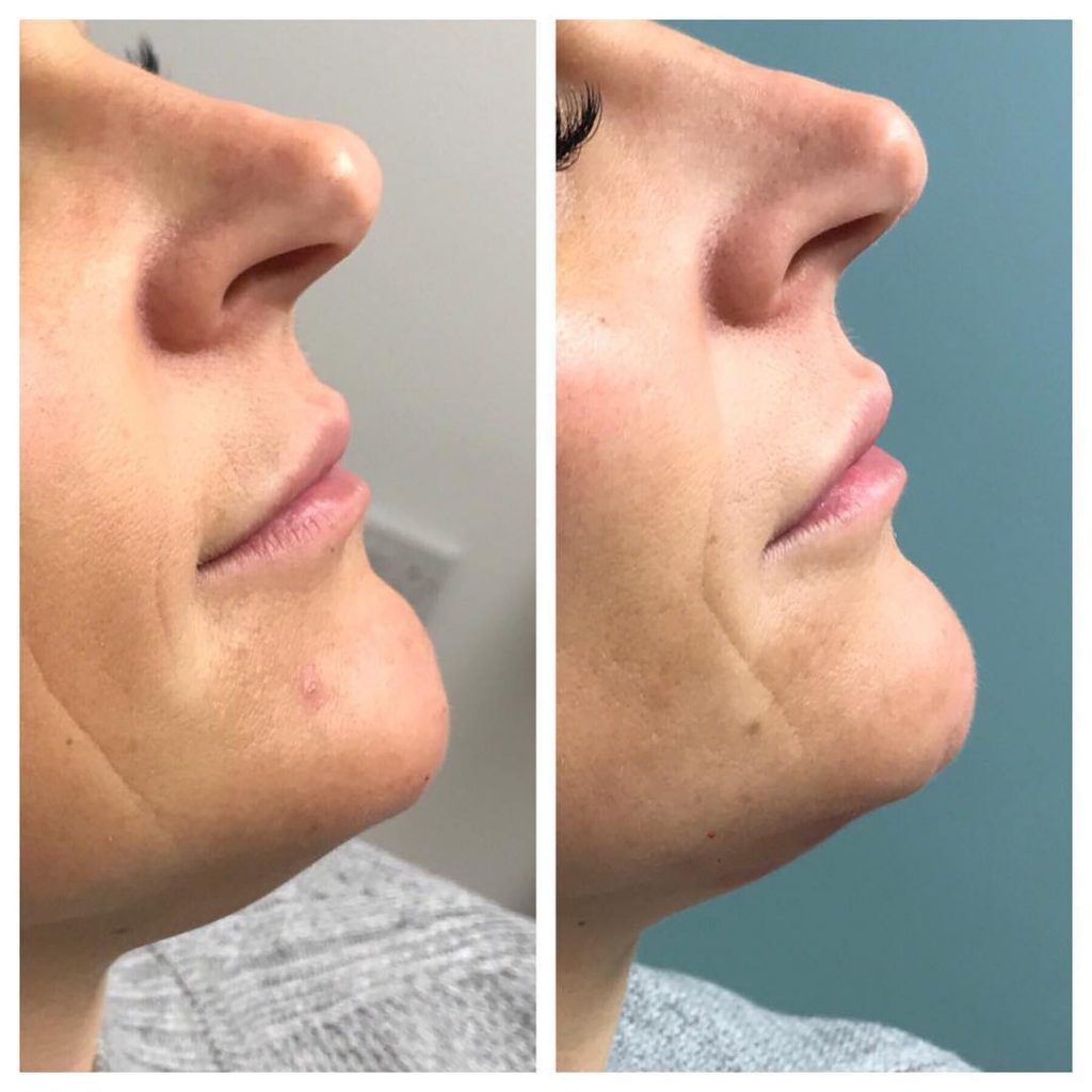 Chin and Jawline Contouring with Dermal Filler Emerald